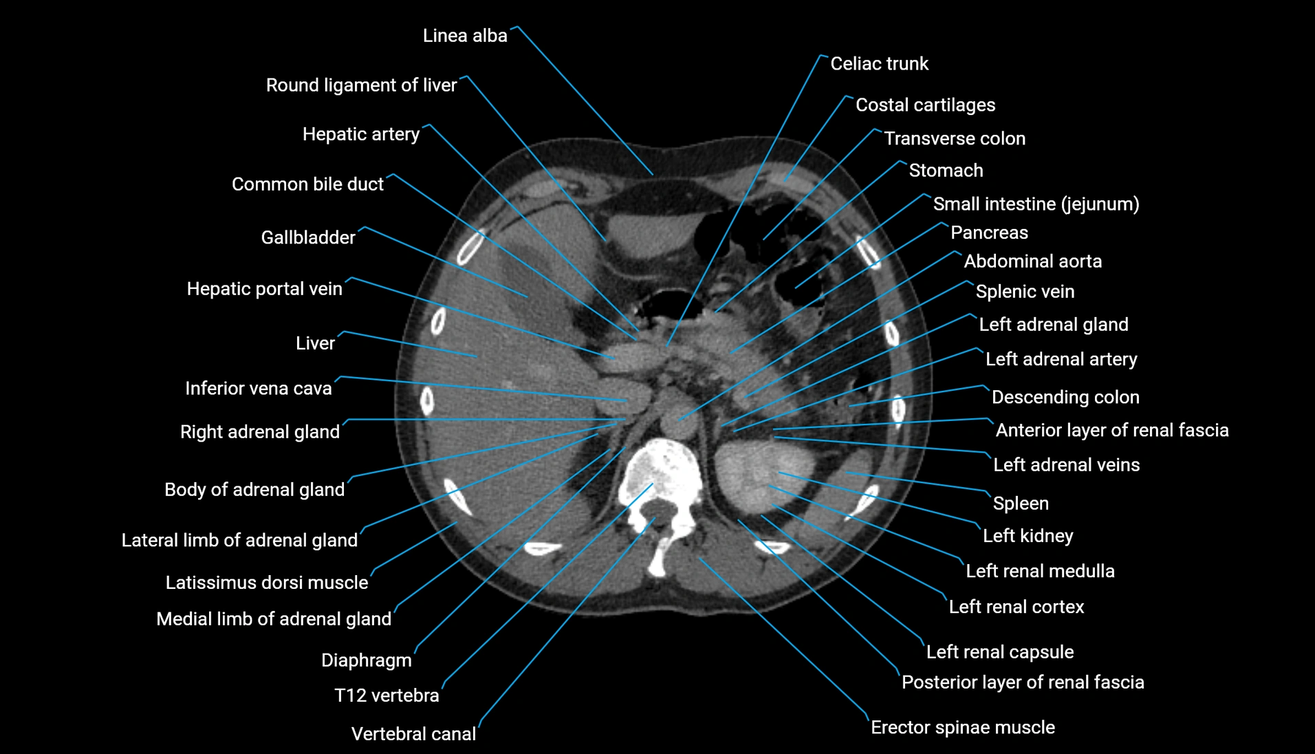 CT urogram axial cross sectional anatomy  labelled radiology image-00076.webp